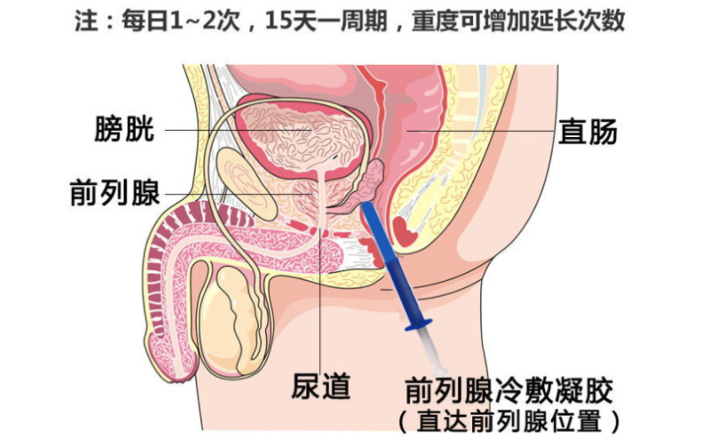 前列腺凝膠的使用.png