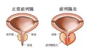 前列腺凝膠貼牌廠家