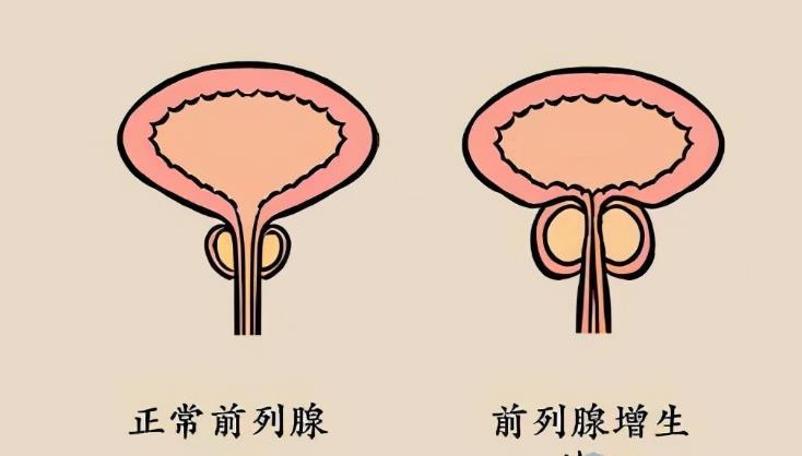 前列腺凝膠加工廠家